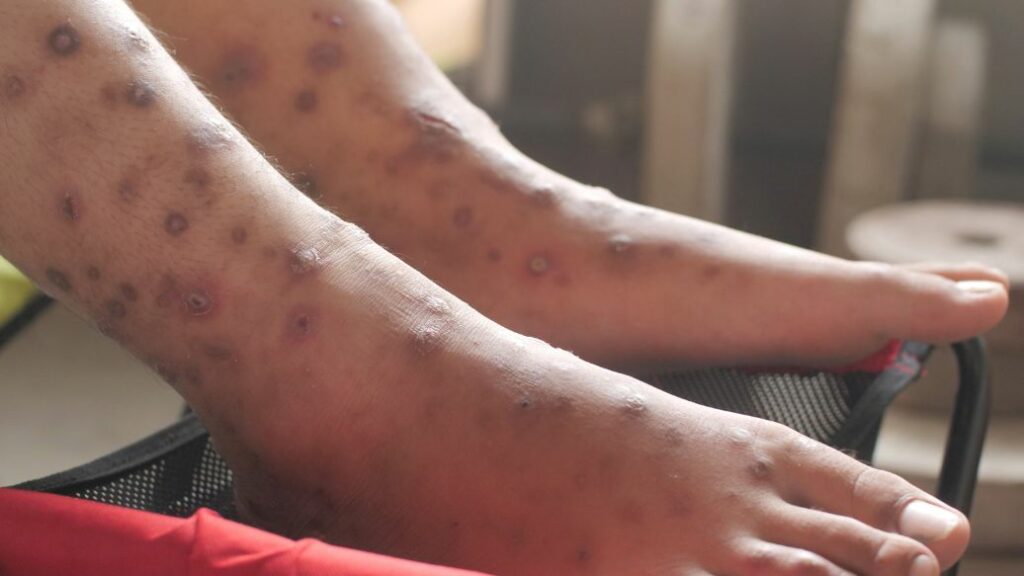 scabies treatment